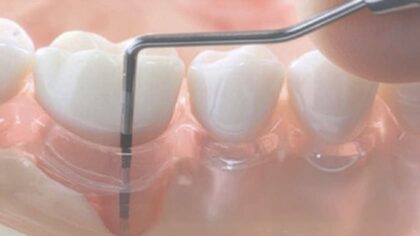 Classification des maladies parodontales